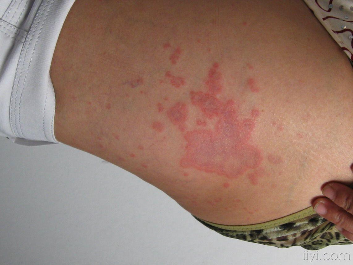 看图识病 - 皮肤及性传播疾病讨论版 - 爱爱医医学论坛 - 爱爱医医学
