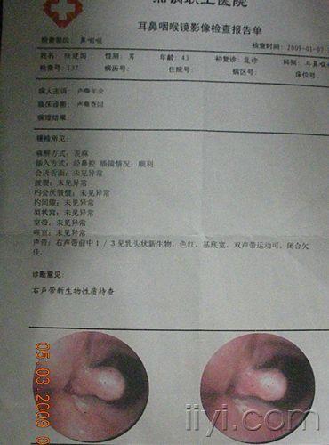 无咽痛,无吞咽疼痛,无咳嗽,无痰中带血,颈部b超未见异常,纤维喉镜见单