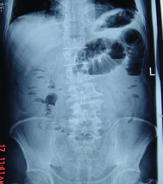 肠梗阻x线图片图片