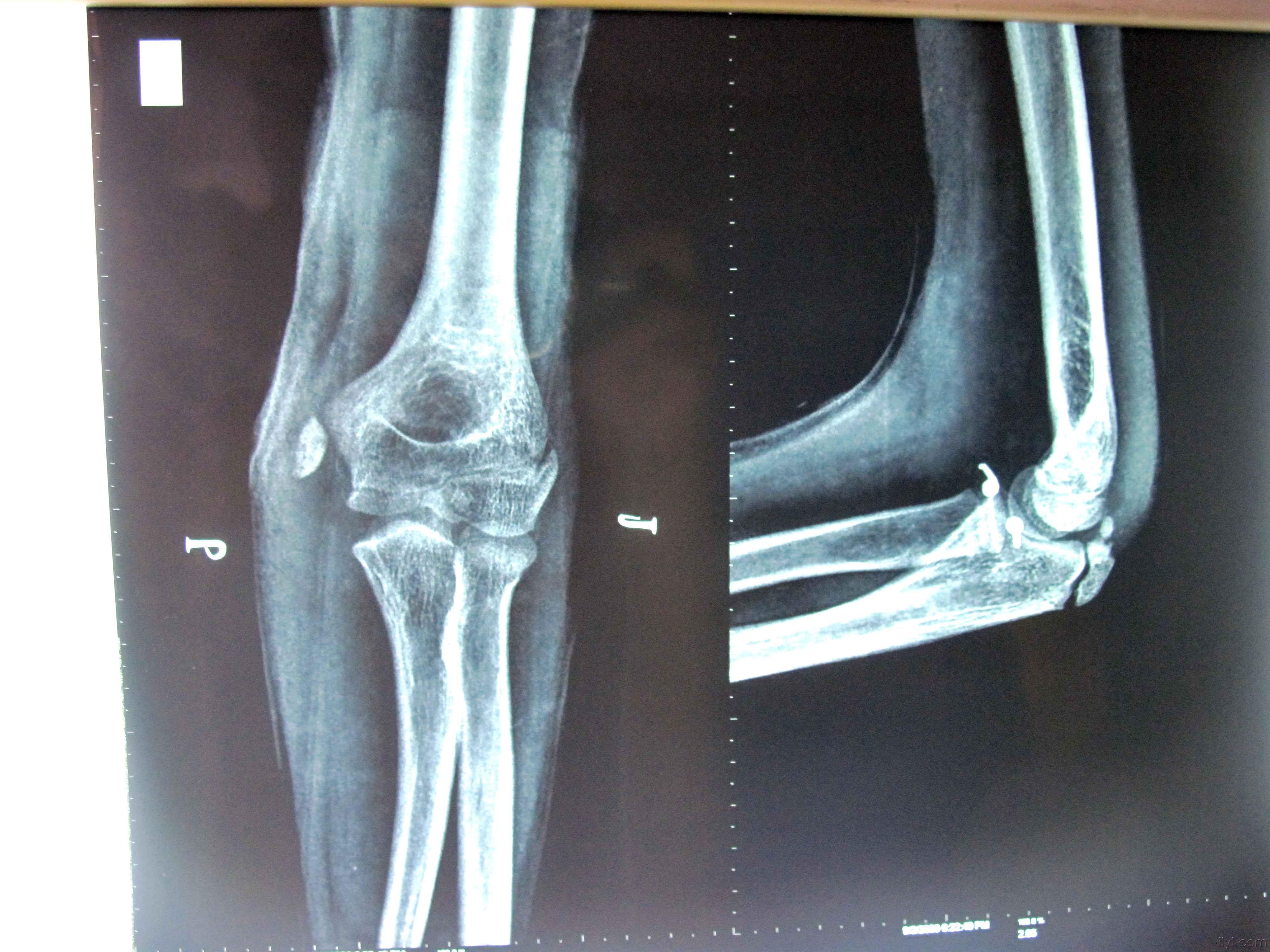 左肘关节脱位合并肱骨内髁骨折