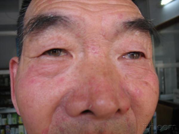 算不算银屑病