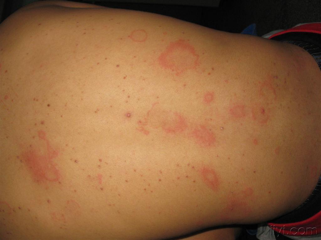 看图识病········急性荨麻疹