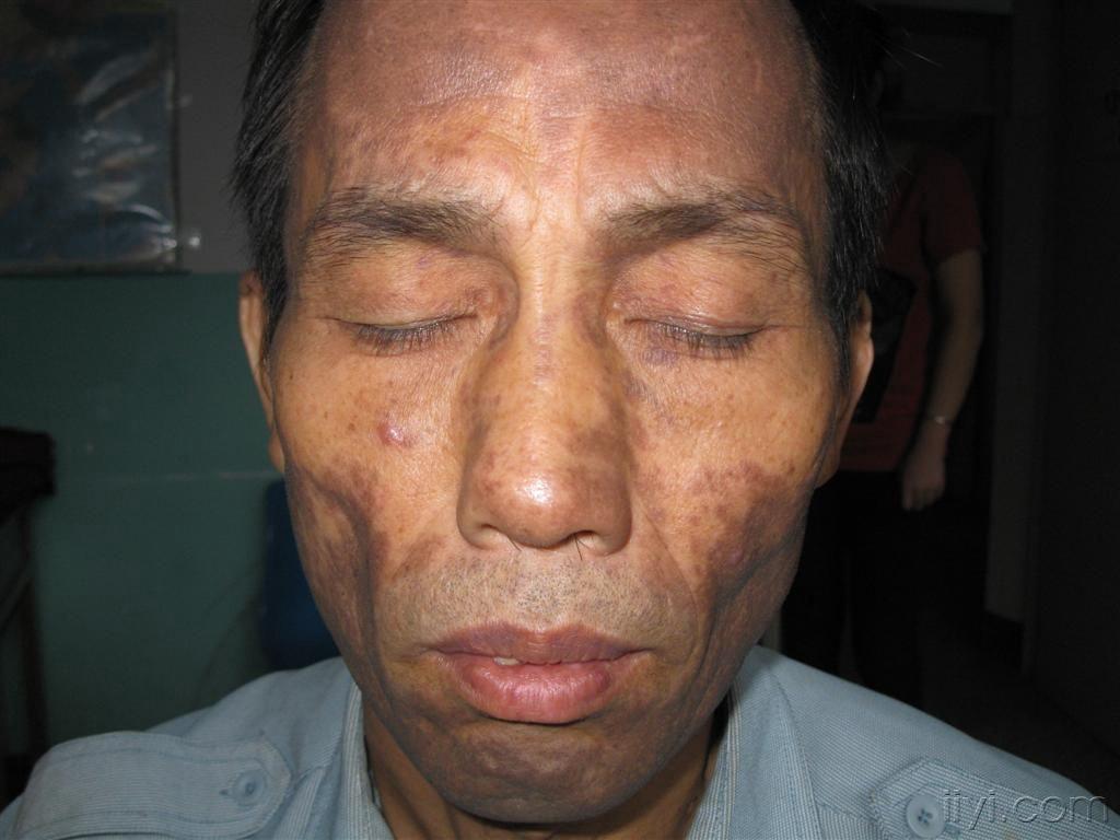 送煤气工·········皮肤黑变病