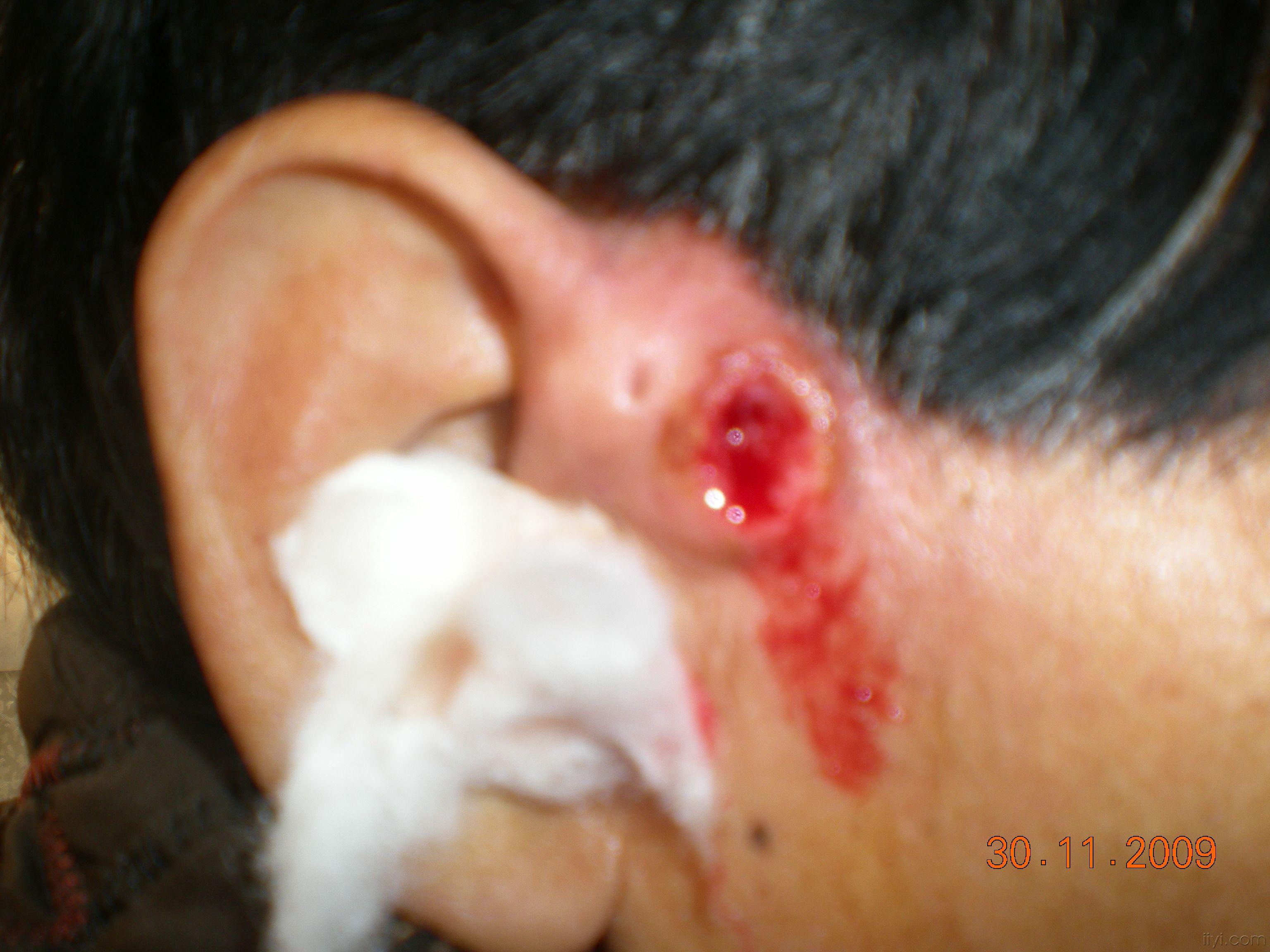耳前漏管化脓感染