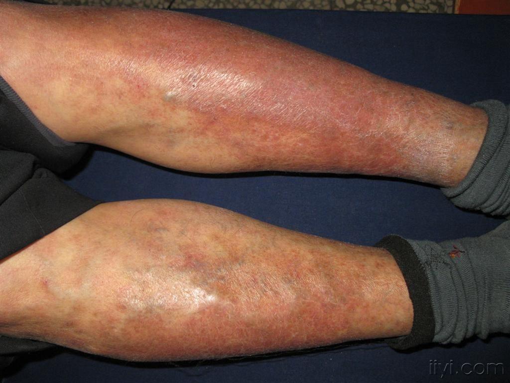 看图识病········郁积性皮炎