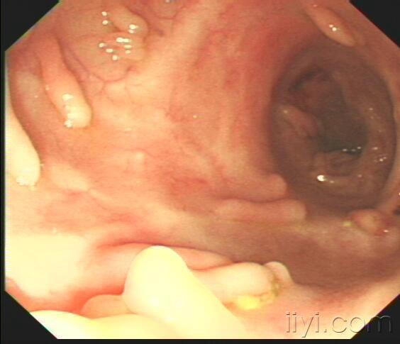 肠道息肉多发图片