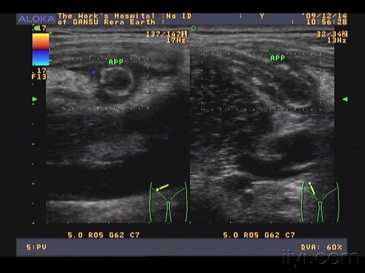 阑尾炎超声图图片