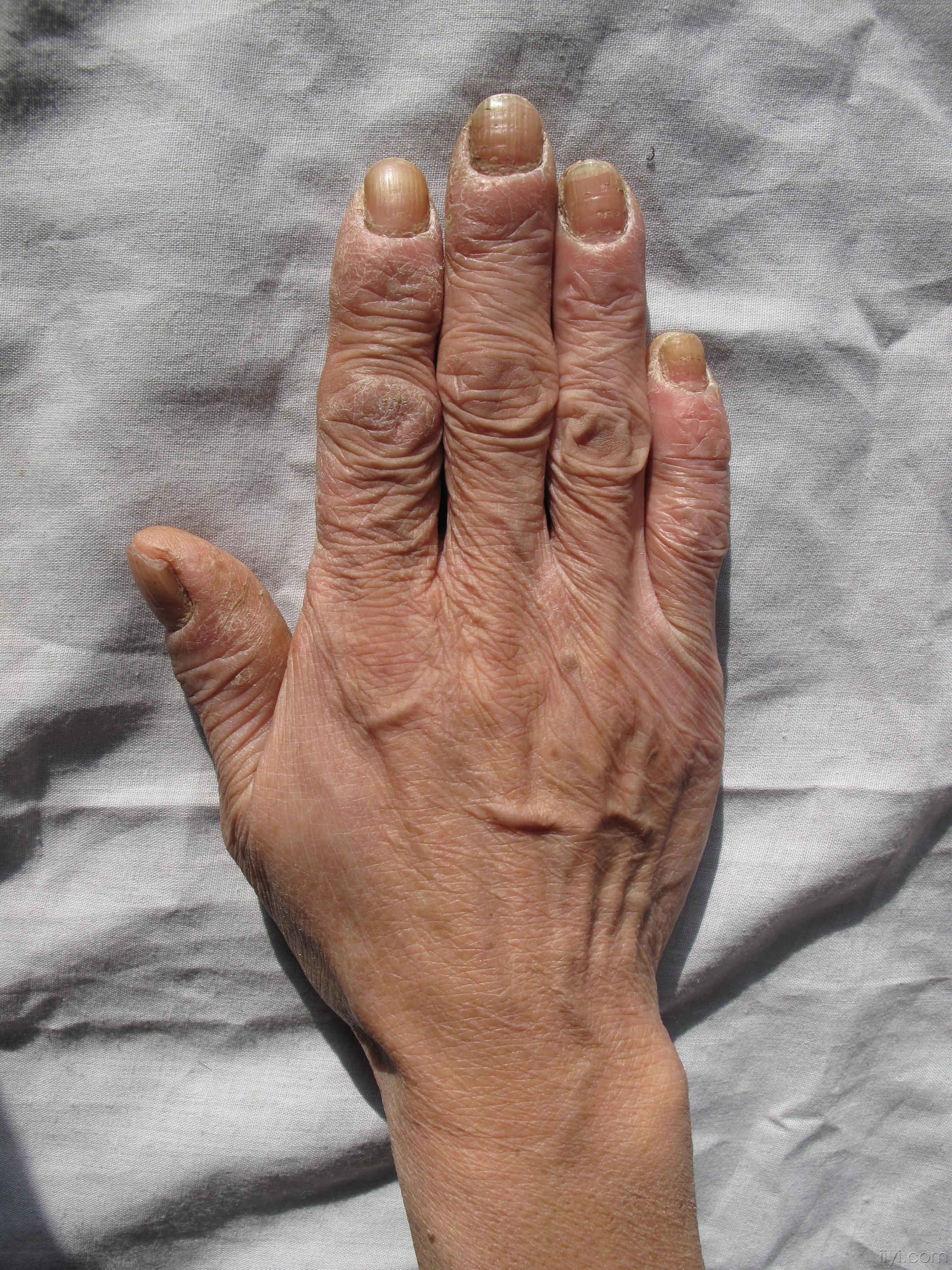 手上皮损半年多---照片太大