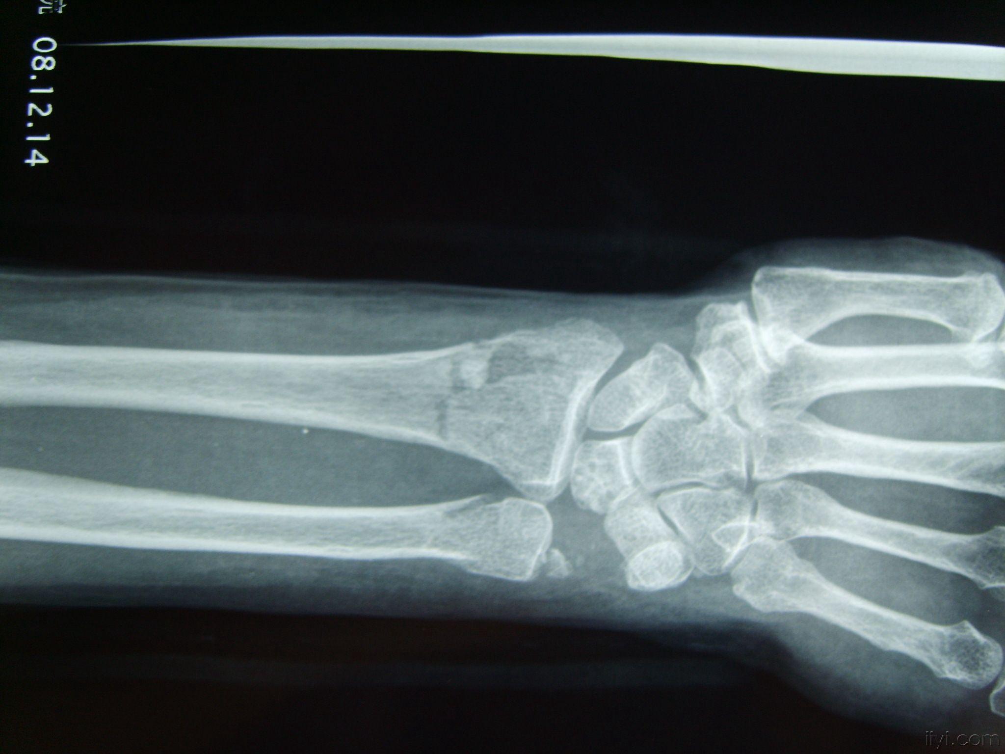 手法复位夹板外固定治疗尺桡骨远端骨折1例