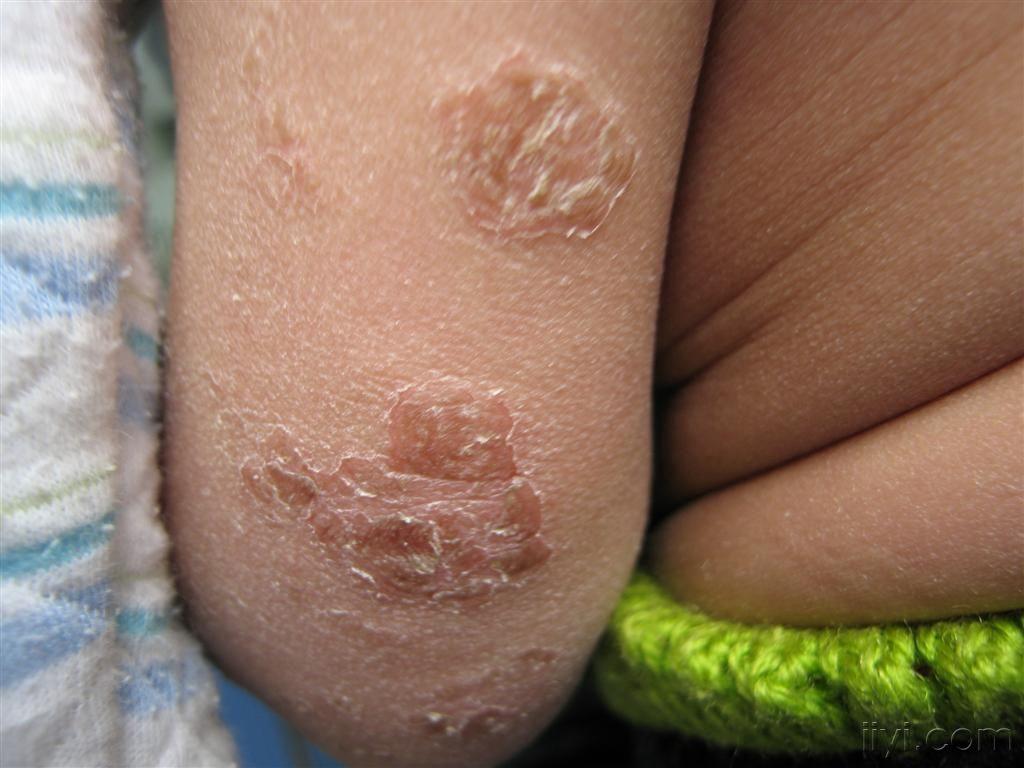 婴儿,9月 - 皮肤及性传播疾病讨论版 - 爱爱医医学论坛 - 爱爱医医学