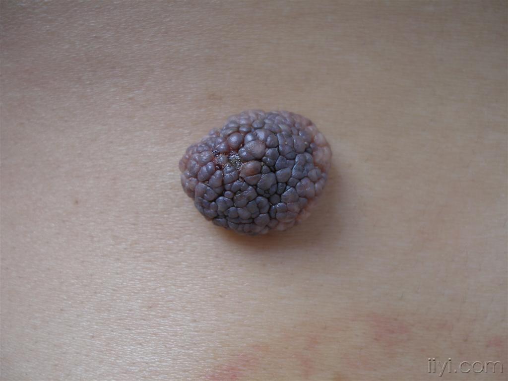 乳头瘤状痣图片图片