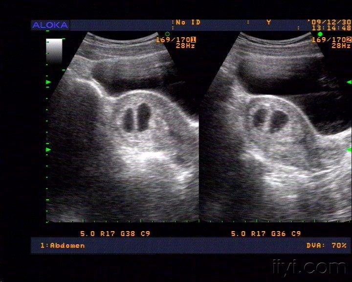 一个孕囊双胞胎先兆图片