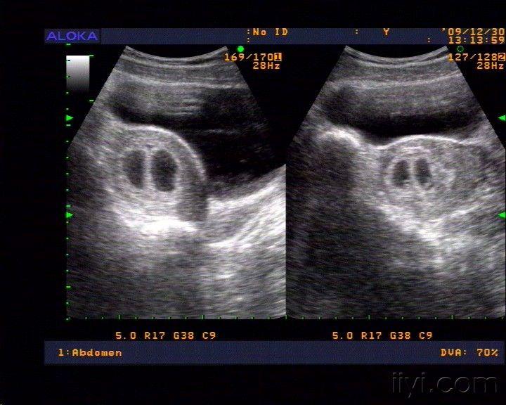 双胞胎妊娠囊图片图片