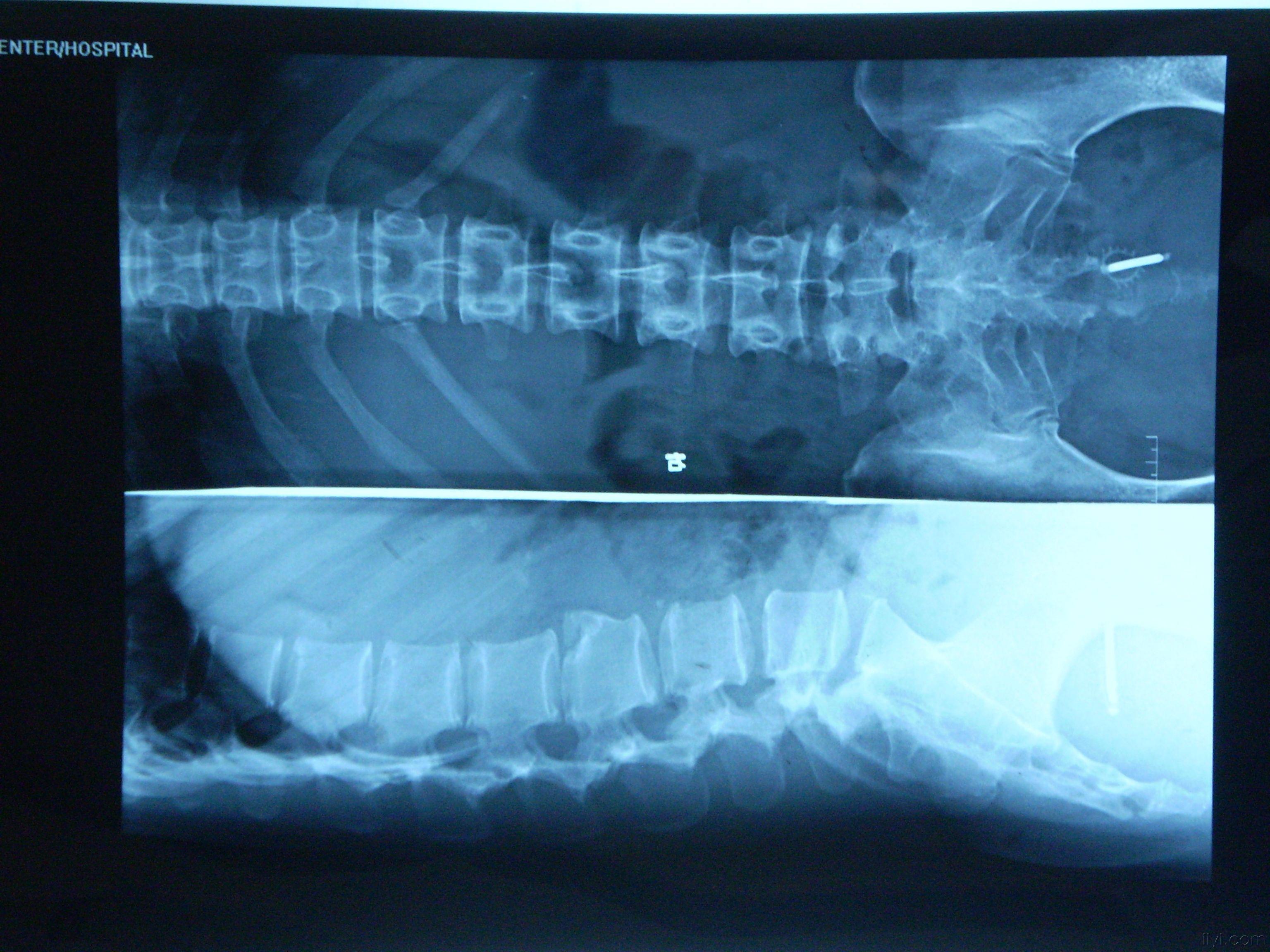 腰肌劳损的x光图片图片