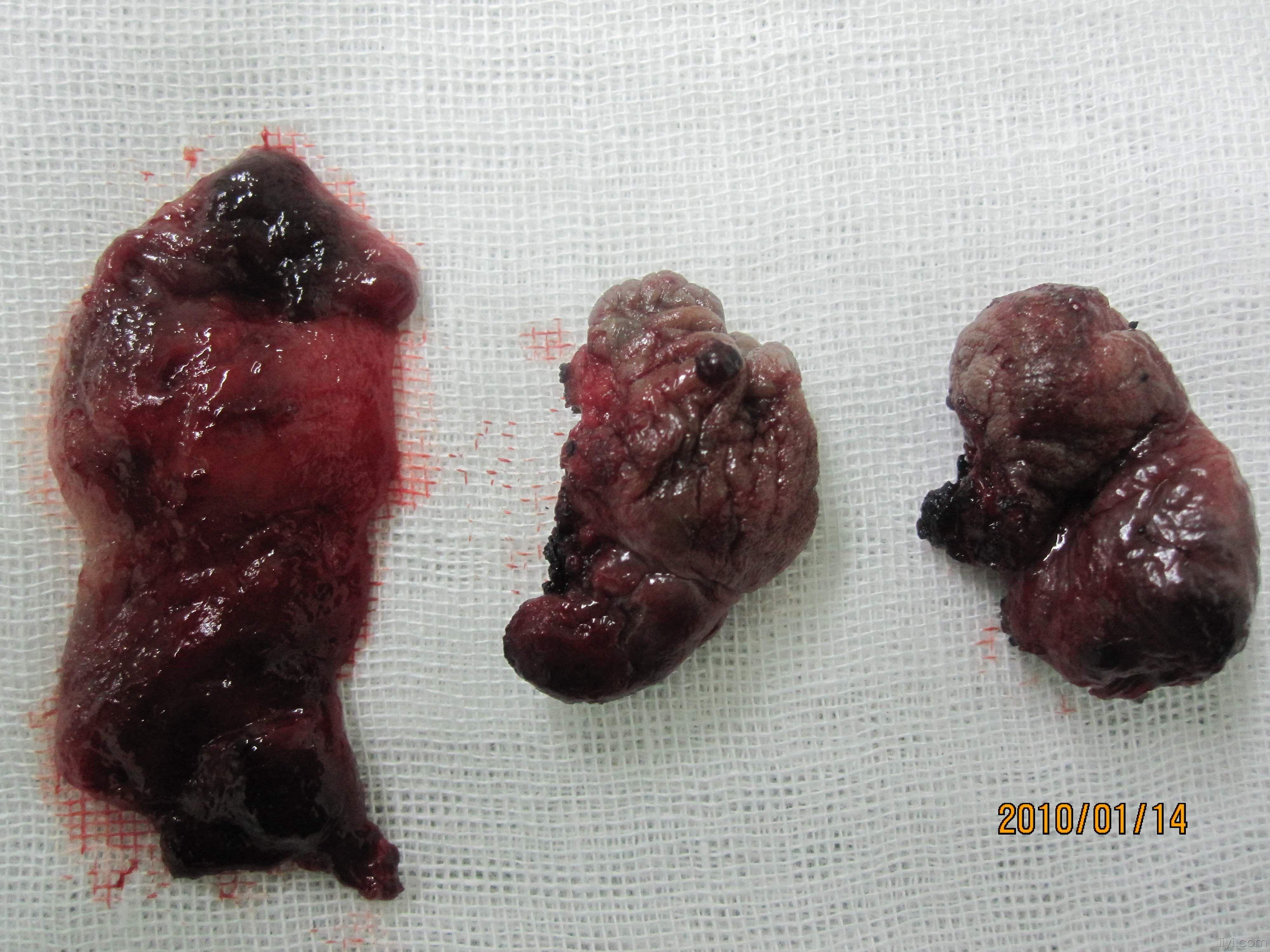Ⅳ度混合痔嵌顿并血栓形成手术图片