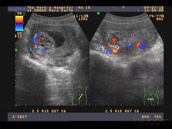 典型之葡萄胎 超声医学讨论版 爱爱医医学论坛 爱爱医医学网