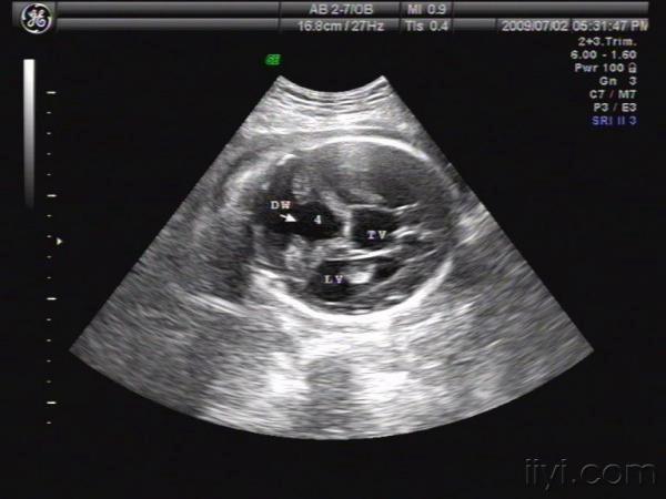 22 13:25:41孕妇晚期妊娠体检,孕35周,孕妇无不适情况,发现胎儿畸形