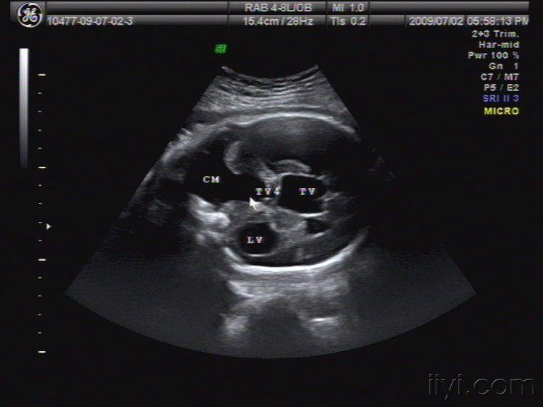 产科畸形-dandy-walker综合征 - 超声医学讨论版 - 爱爱医医学论坛