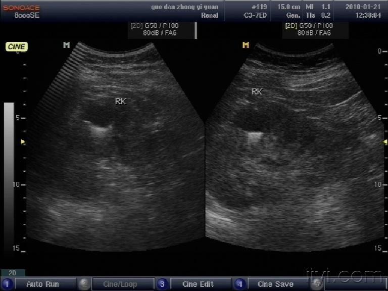 肾钙乳症超声图片图片