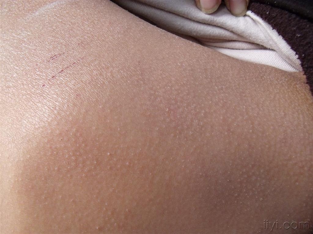 看看是什么病?-最终答案:毛发红糠疹