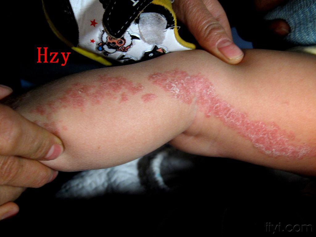 母亲为13个月婴儿左下肢的皮损苦恼公布答案:线状苔藓
