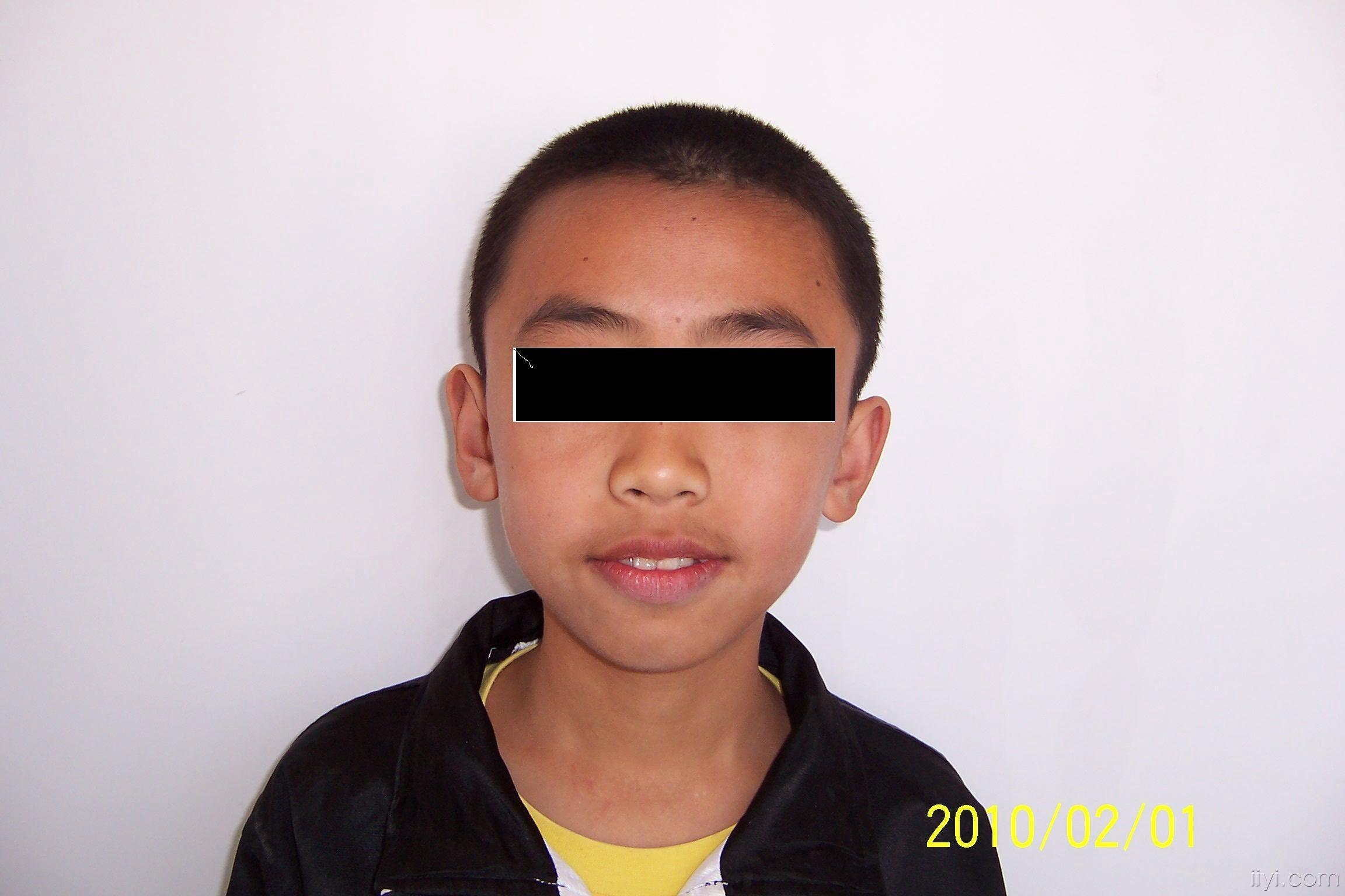 新收的开 牙合 病人,请大家畅所欲言,说得好的加分 - 口腔医学专业讨