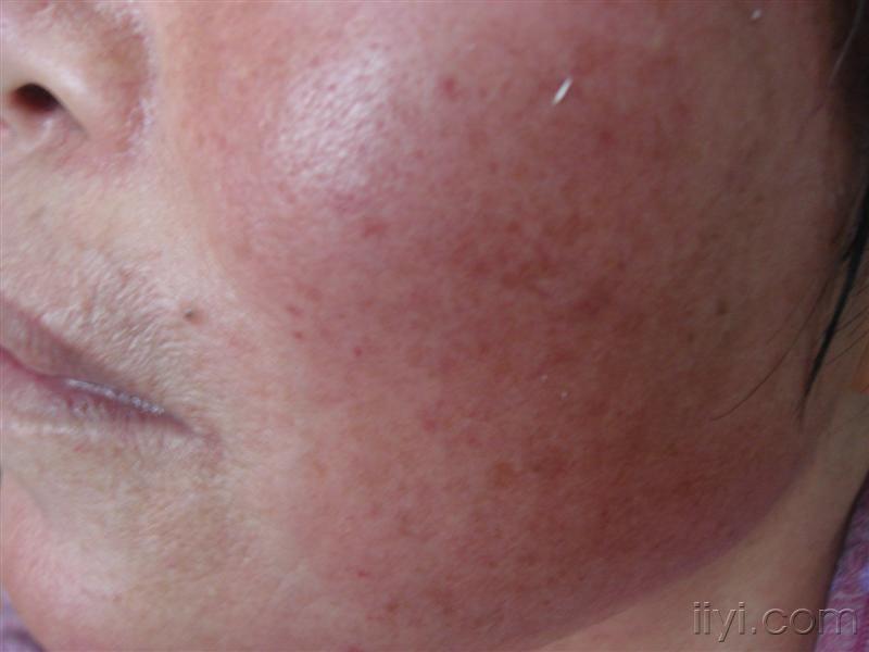 15:49:08女性,56岁,反复发作的脸部皮肤潮红发热3年余,无痛无痒,查体