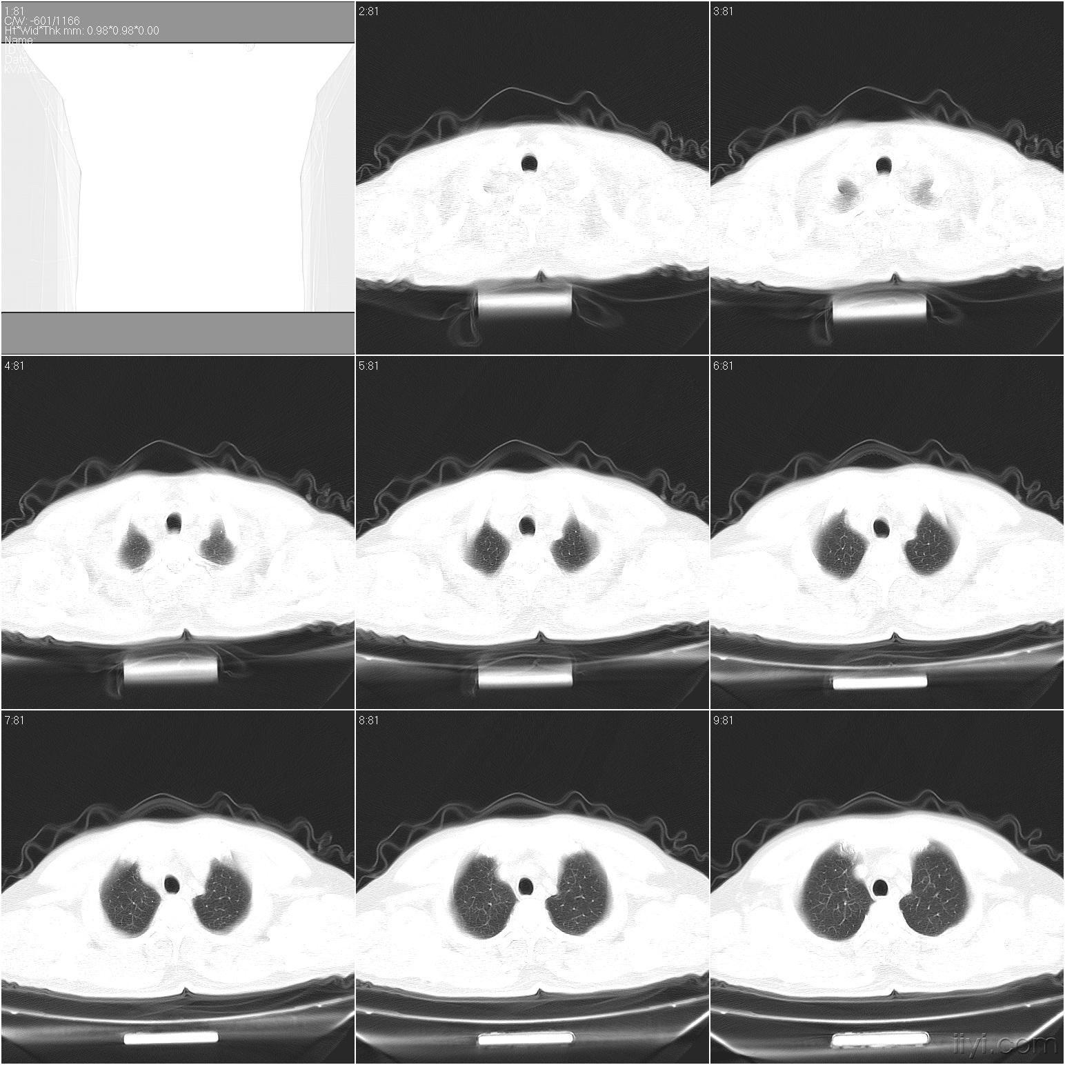 肺部ct,請同行幫忙閱片!