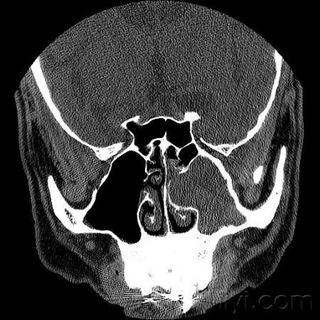 請看一鼻竇ct病例