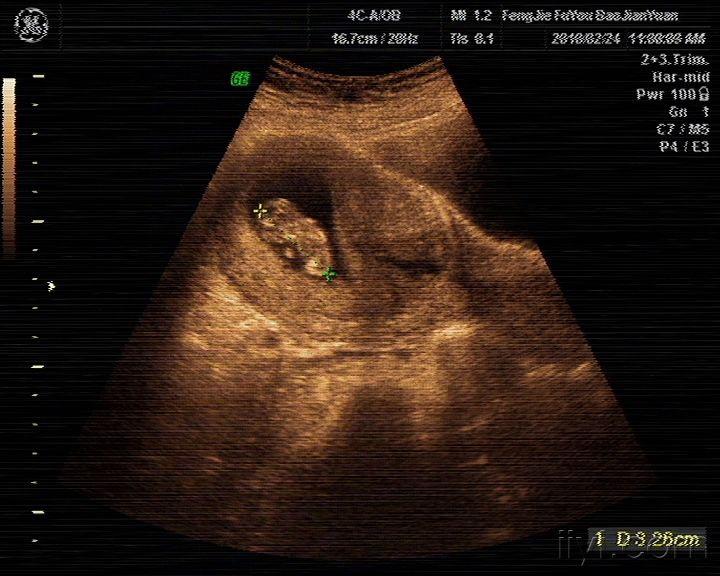 节育环移位(嵌顿可能)