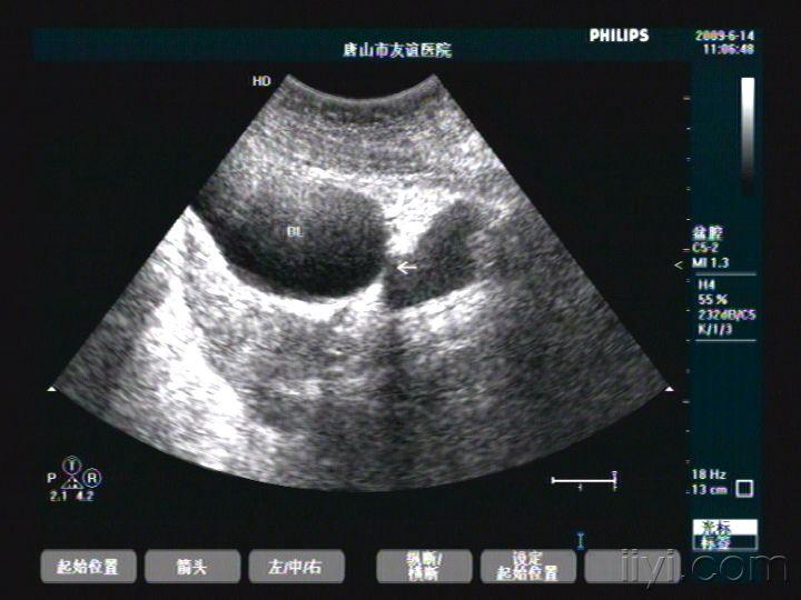 膀胱憩室 - 超声医学讨论版 - 爱爱医医学论坛 - 爱爱医医学网