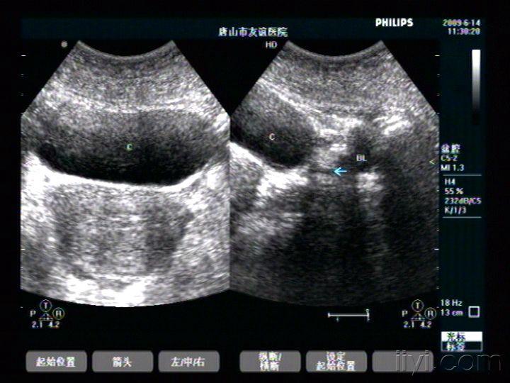 膀胱憩室 - 超声医学讨论版 - 爱爱医医学论坛 - 爱爱医医学网