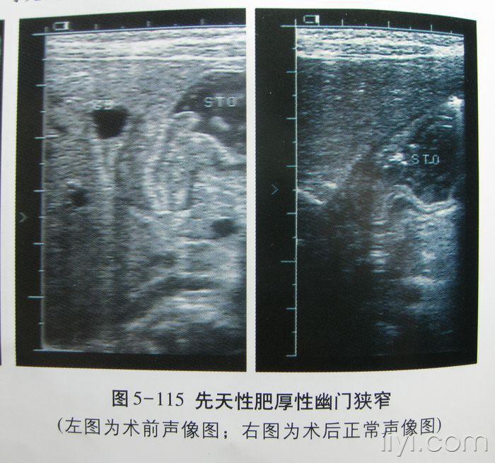 先天性肥厚性幽门狭窄--图片 - 超声医学讨论版 - 爱爱医医学论坛