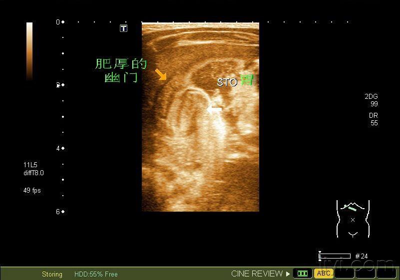 先天性肥厚性幽门狭窄--图片