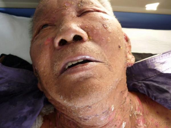 全身红斑水疱六天 - 皮肤及性传播疾病讨论版 - 爱爱医医学论坛