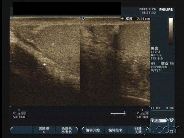 附睾肿块,大家看看.已公布病理结果!