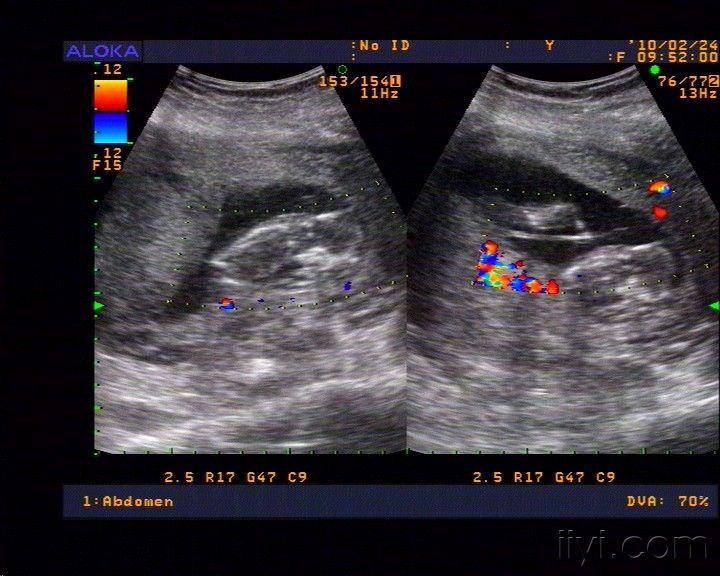 双胎妊娠(双胎盘,双胚胎停育,其中一个是否是纸样胎儿?