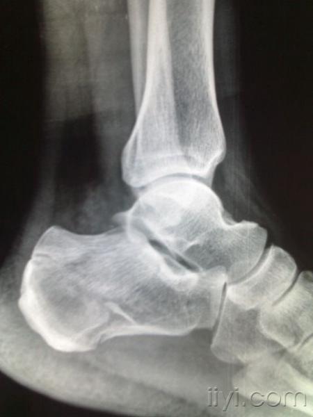 伤后跟踝部中度肿胀如x片所示,请问大家这例跟骨骨折的治疗方案?