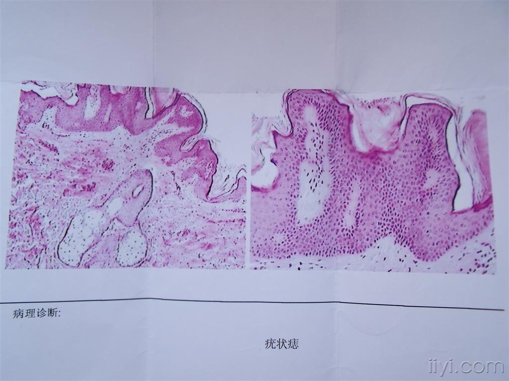 线性疣状痣-门诊照片