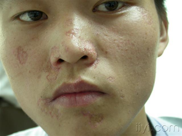 请您诊断(考虑:1,虫蚀状斑状萎缩;2,特发性皮肤萎缩;3,皮肤痘疮样斑状