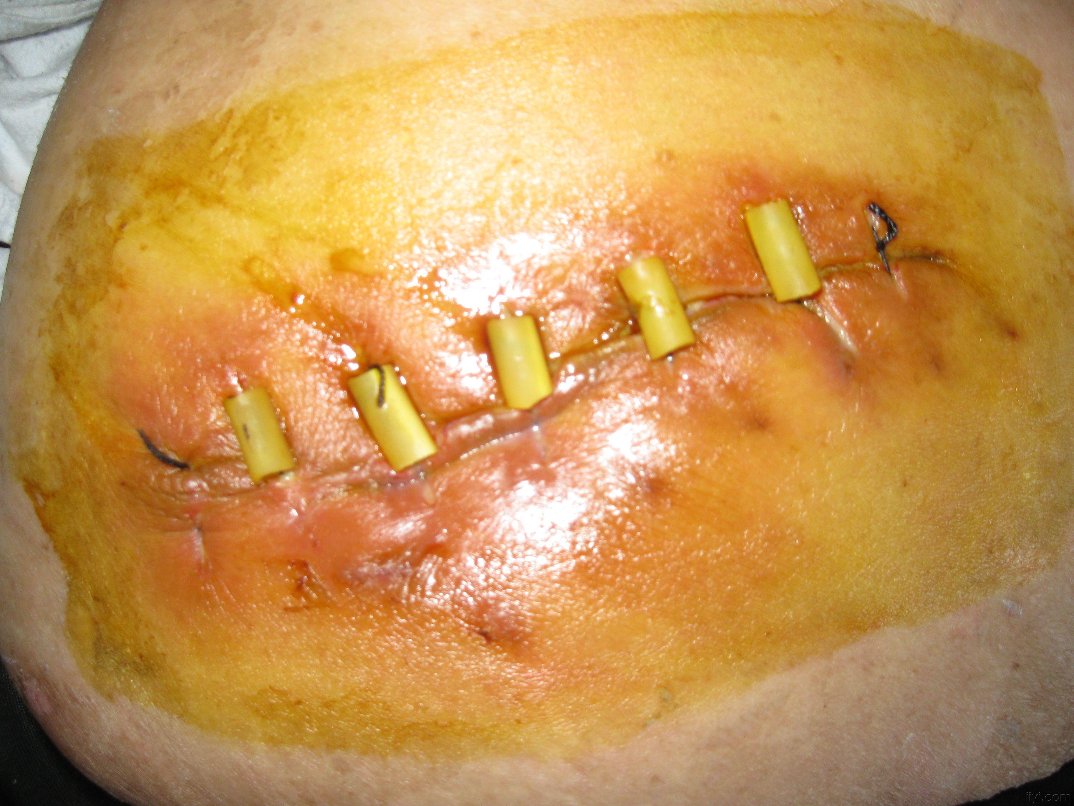 胆结石手术伤口图片