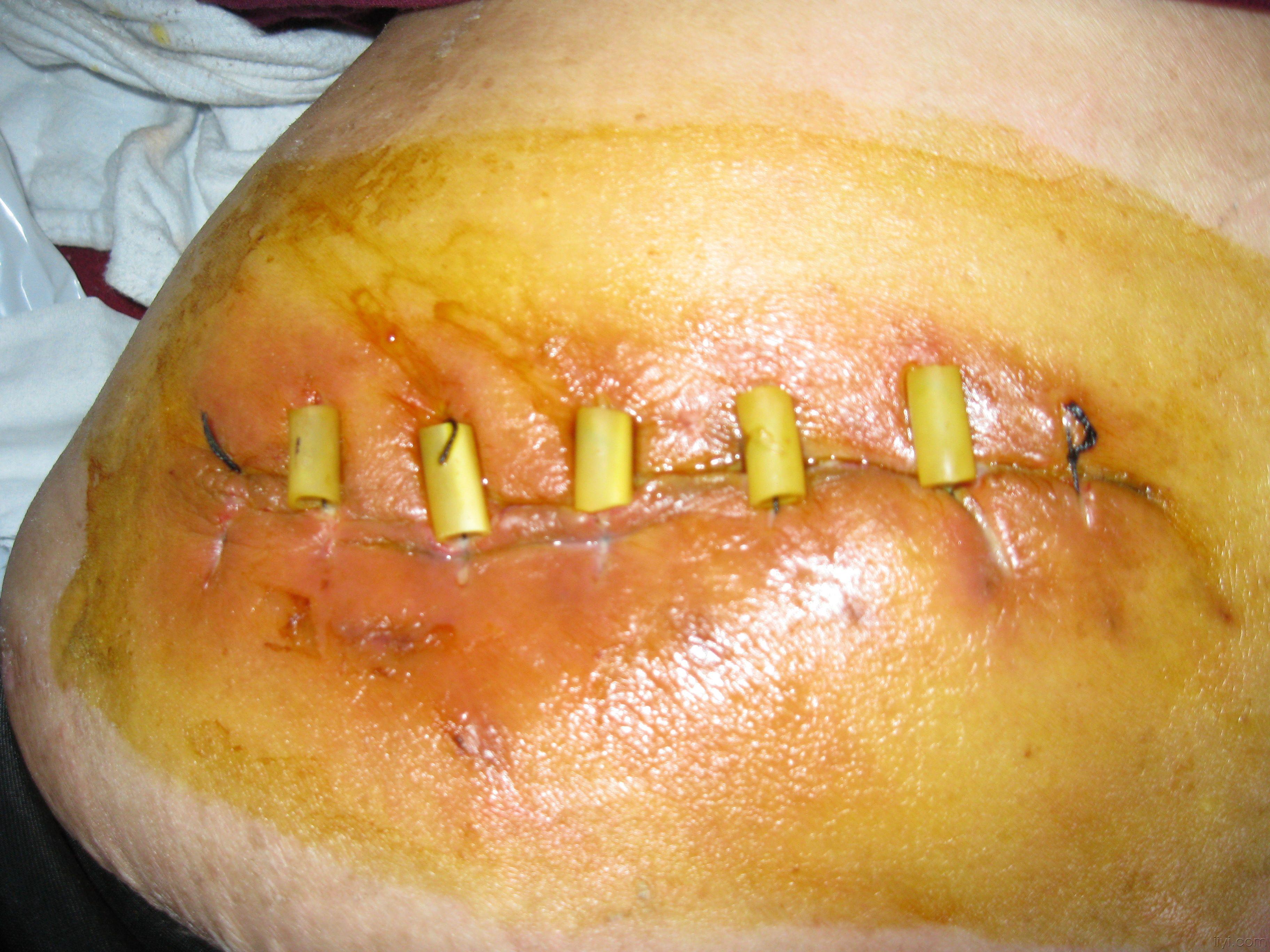 胆囊炎手术刀口图片图片