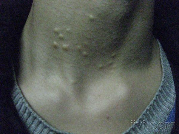 是否皮脂腺囊肿