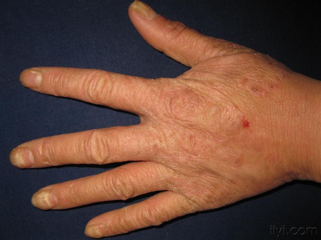 看图识病-------------手癣,甲癣.