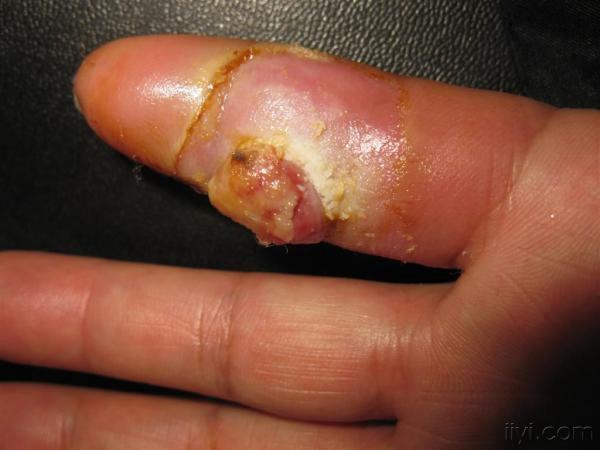 手指伤口感染肿胀图片图片