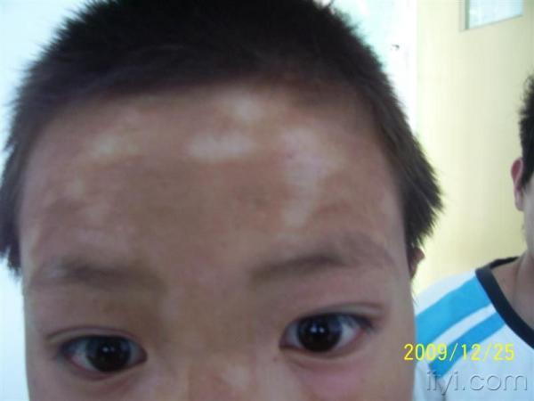 宝宝虫斑脸部图片图片