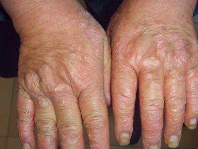 于一年前无明显诱因出现手部痒,脱屑,微痛,发病后在县级医院诊断手廯