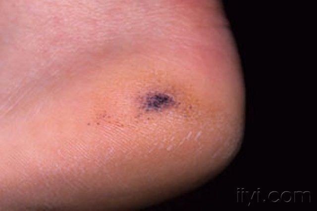 典型病例展示6--公布答案黑踵