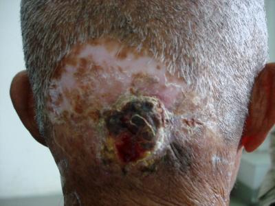 疤痕癌的早期症状图片图片