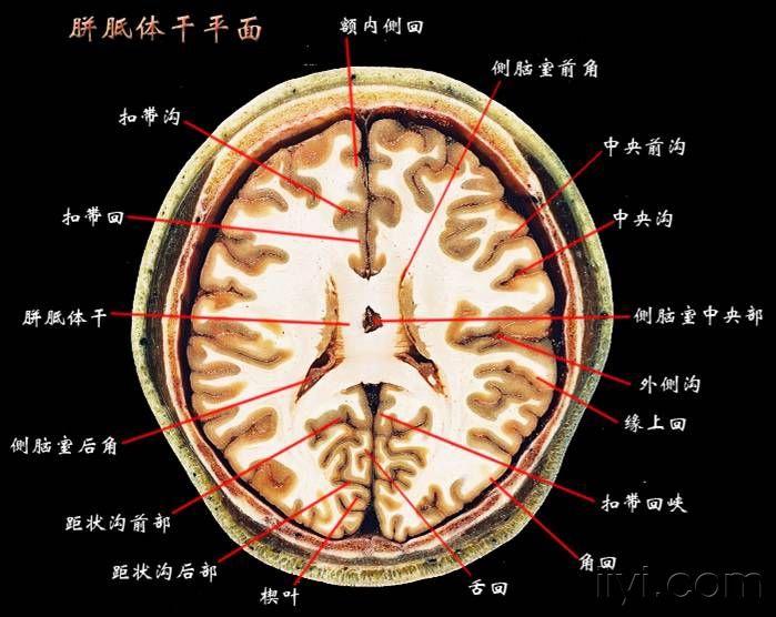 侧脑室断层解剖图图片